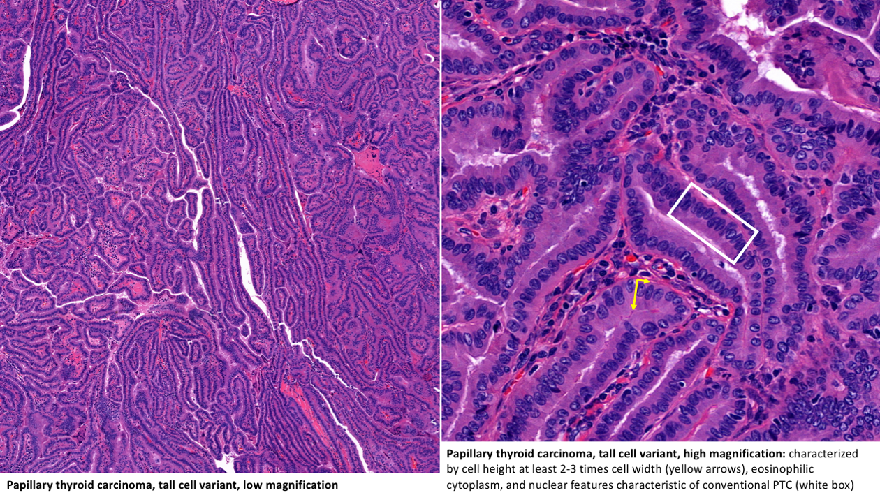 Variants of Papillary Thyroid Carcinoma (Microcarcinoma